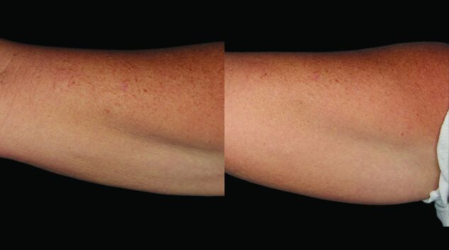 Coolsculpting results