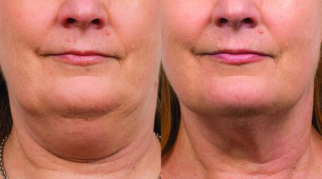 coolsculpting chin results