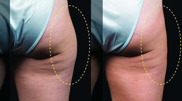 coolsculpting real results