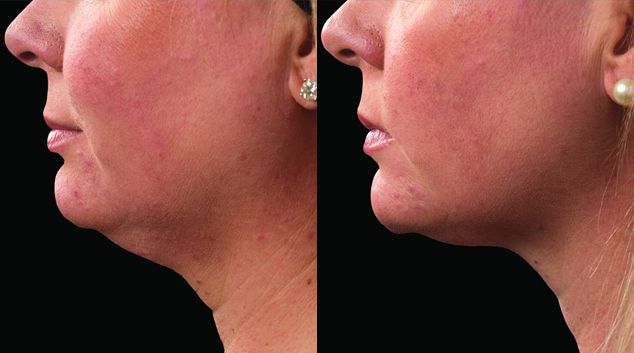 coolsculpting before and after