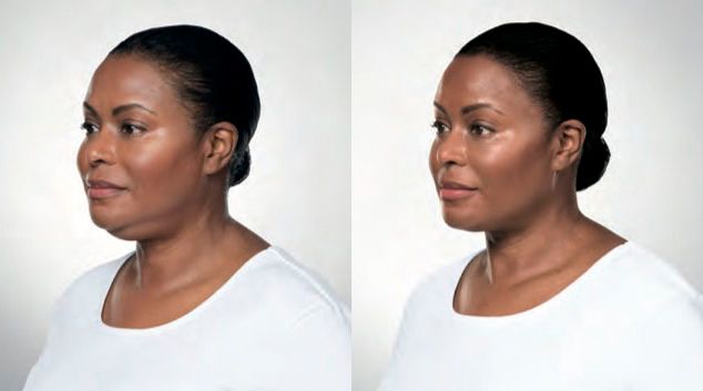 Kybella results