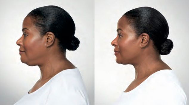 Kybella before and after