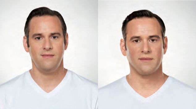 Kybella chin results