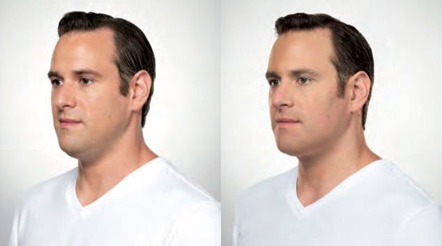 Kybella results photos