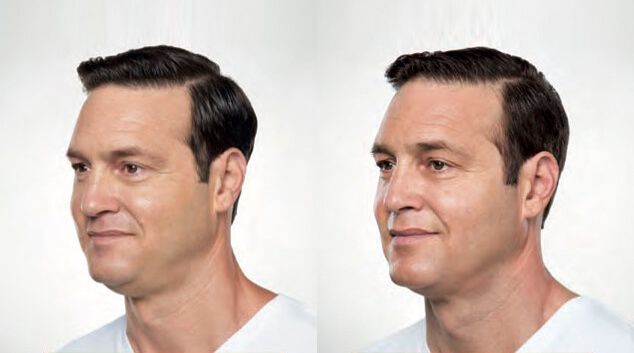 Kybella fat reduction