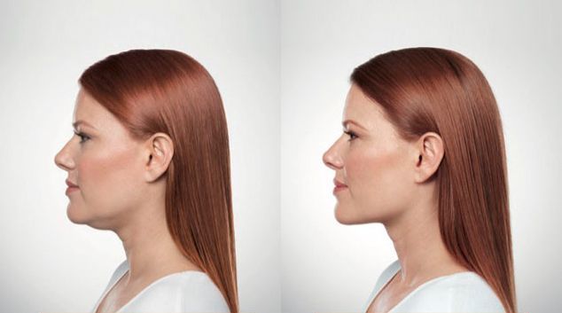 Kybella injection results