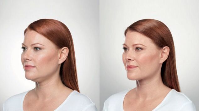 Kybella before after