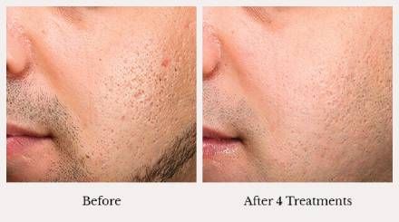 Microneedling acne treatment