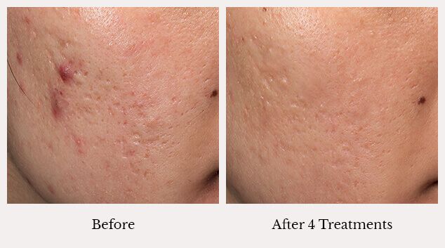 Microneedling acne results