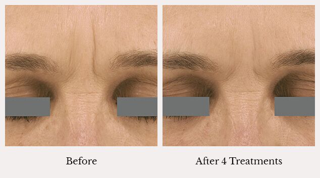 Microneedling wrinkle treatment