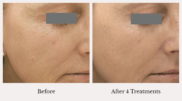 Microneedling wrinkle results