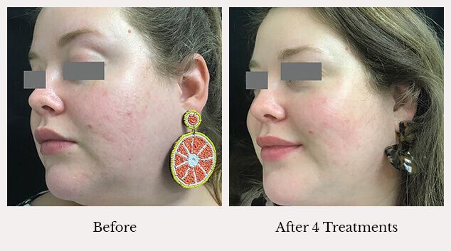 Microneedling skin treatment