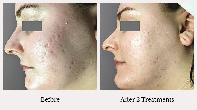 Microneedling facial results