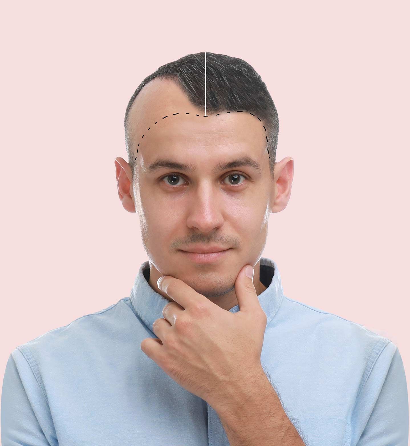 FUE Hair Transplant Beverly Hills