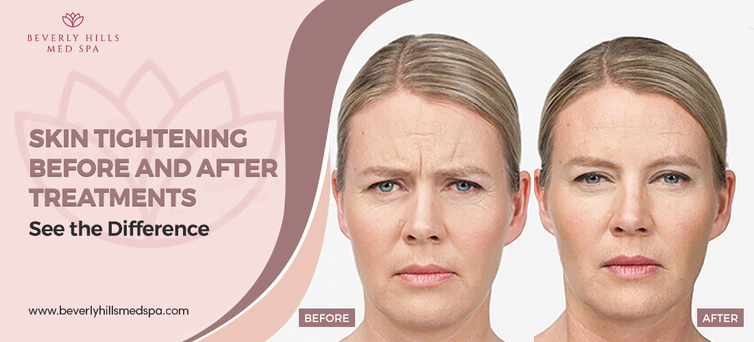 Skin Tightening Before and After Treatments: See the Difference