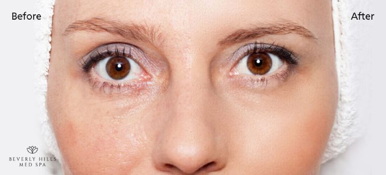 Does Microneedling Work To Stimulate Skin and Make You Look Younger?