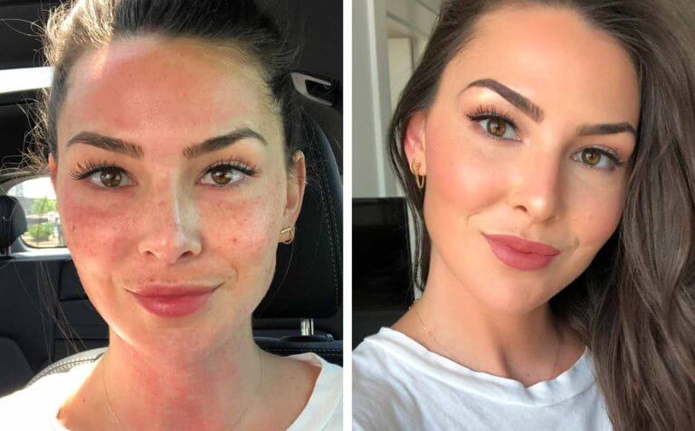 is microneedling worth it