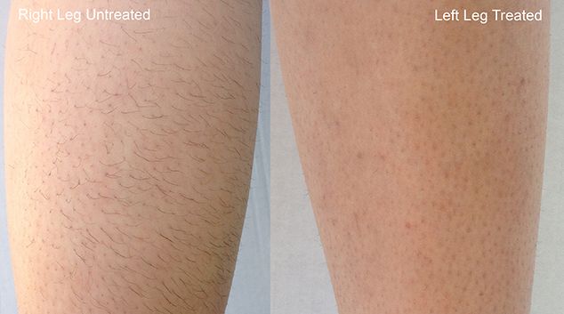 Laser hair removal before after