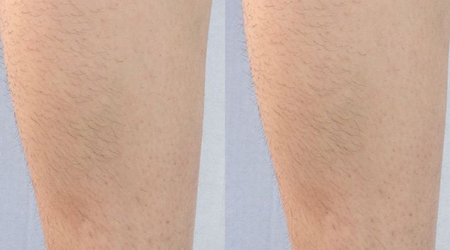 Laser hair removal treatment