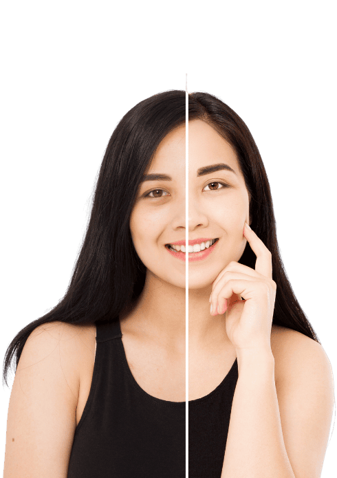 Dark Circles & Under-Eye Bags